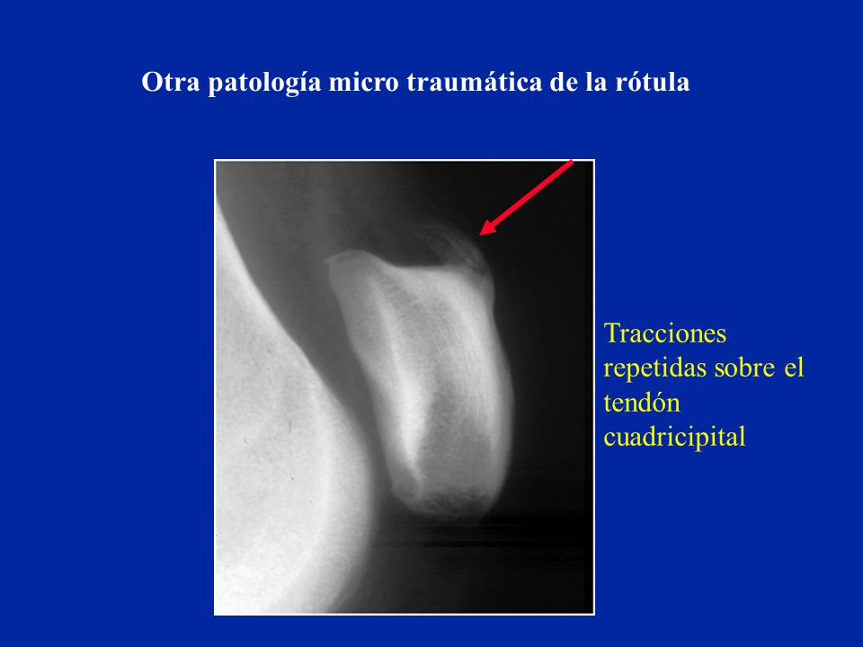 Los ejercicios a las hernias sheynogo del departamento de la columna vertebral s5-s6
